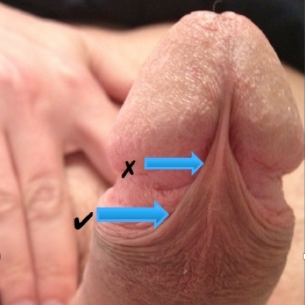 Frenum piercing penis